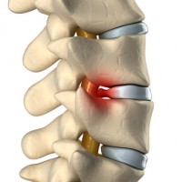 Disc herniated